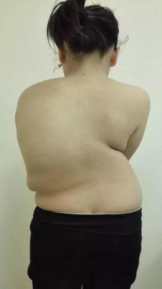 15岁女孩儿朱小慧患有严重的脊柱侧弯
