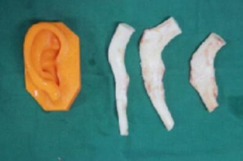 耳軟骨進行再造