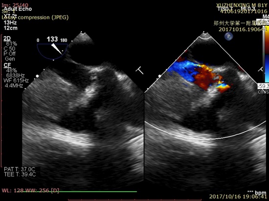 患者男，84岁，主动脉瓣重度狭窄经股动脉TAVR术前食管超声