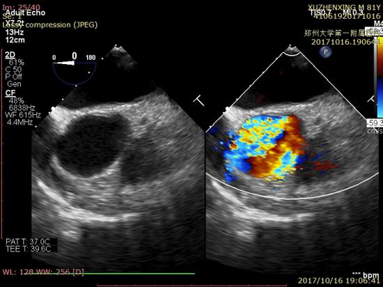 患者男，84岁，主动脉瓣重度狭窄经股动脉TAVR术后食管超声