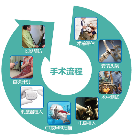 脑起搏器手术流程