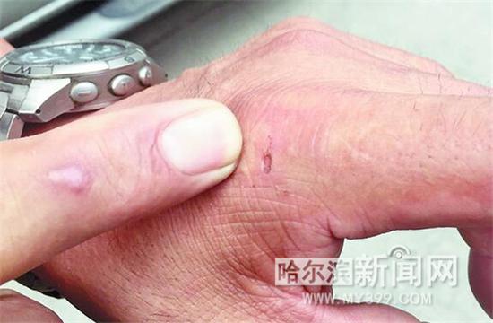 胡老汉被咬伤的手。