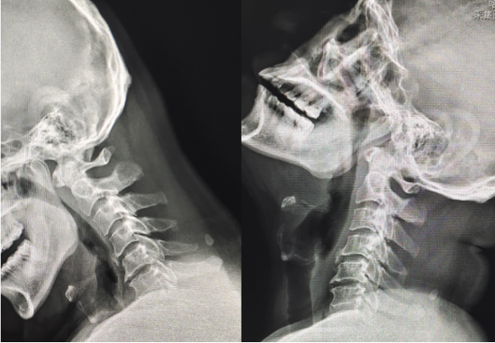 颈椎X线示：颈椎退变，椎间孔狭窄