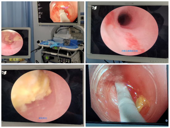 经口胆道镜见阑尾炎症、化脓、粪石取出