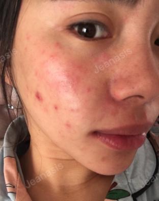 我用15天治愈了我一年多的激素脸