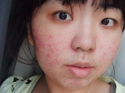 脸上螨虫过敏怎么办?看看这几个小窍门!