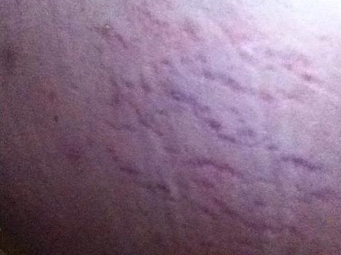 肥胖纹怎样才能去掉?碧芙源去纹抹平尴尬4招轻松搞定_新浪黑龙江_新浪网