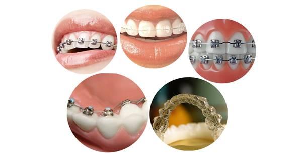 廊坊隐形矫正牙套要多少钱_新浪黑龙江_新浪网