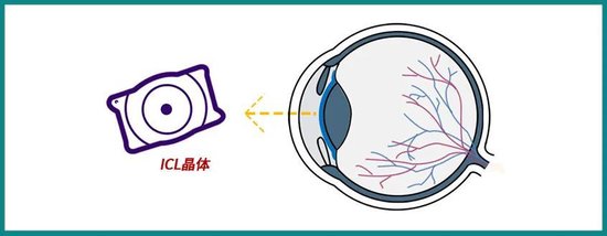 中低度近视手术可以做晶体植入手术吗？