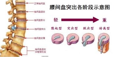腰间盘突出压迫神经腿疼怎么办 详细分析解答
