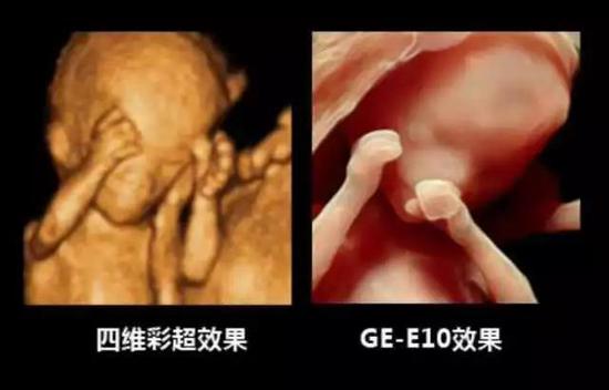 孕妈福利来啦!美国GE-E10超清四维彩超直降400元!快快约起吧!
