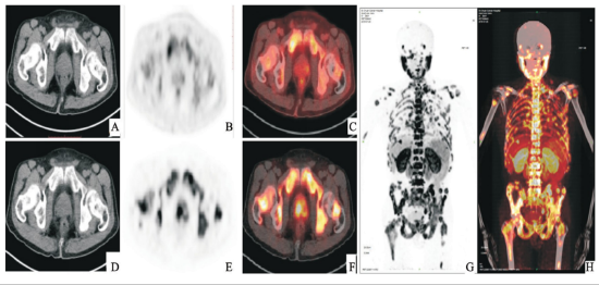 pet-scan-lymphoma