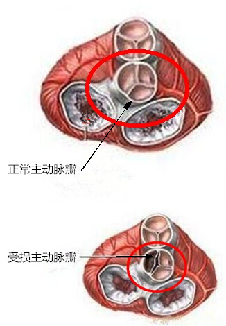 中重度主动脉瓣狭窄,伴轻度关闭不全的治疗