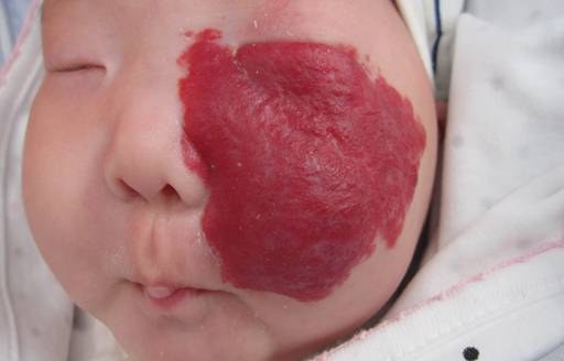 2月26日哈市儿童医院皮肤科将举行儿童血管
