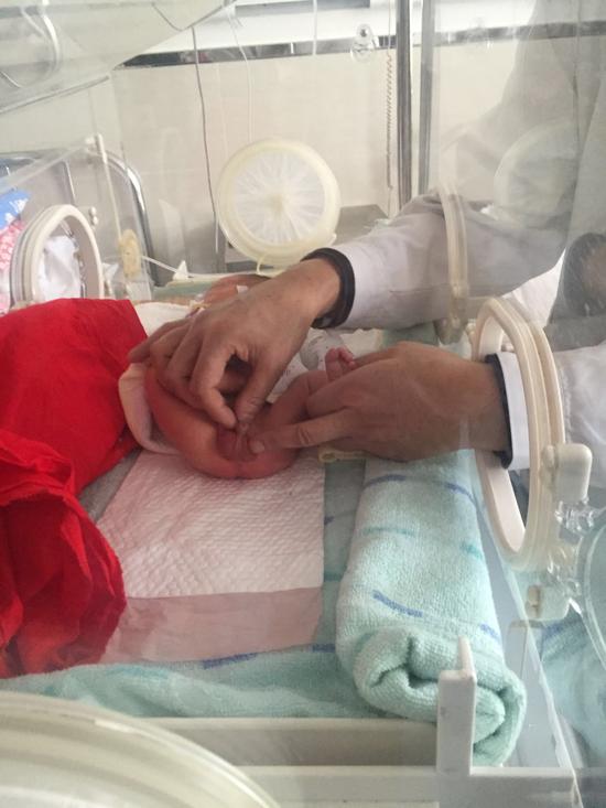 哈尔滨市儿童医院普外二科 救治"先天性肛门闭锁"早产