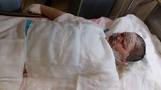 民房火灾祖孙3人被烧伤 哈市五院全力救治