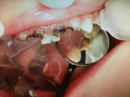 哈市儿童医院口腔科开展牙齿疾病舒适治疗