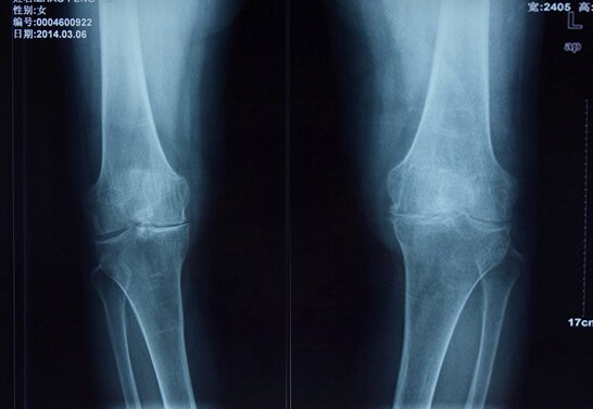 病例术前双膝X片