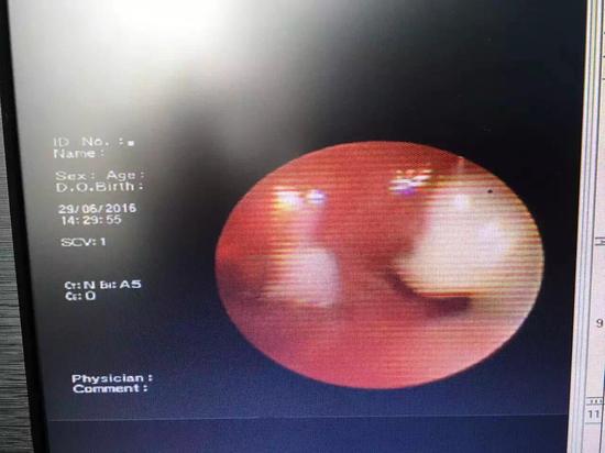 5岁幼童疯狂发烧 肺部炎性分泌物形成胶状支