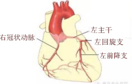 三支病变,是指冠脉的三支重要血管右冠状动脉,左冠状动脉前降支,左