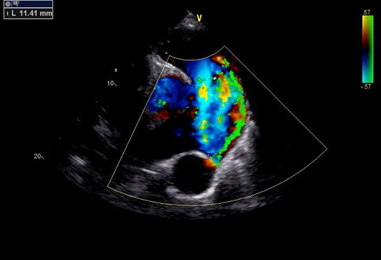 动一气呵成 远东医院修复大龄先心病患者心脏