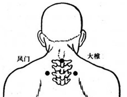 颈背三个风口护心