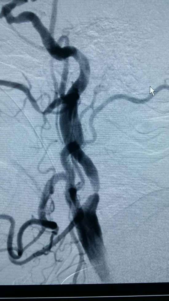 【新浪医讯】患者双侧颈内动脉狭窄 远东两次支架植入