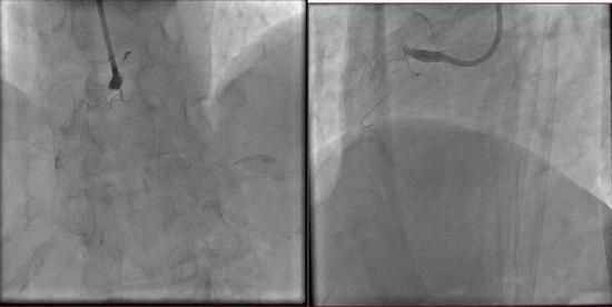医院慢性全梗阻CTO介入手术 打通冠状动脉再