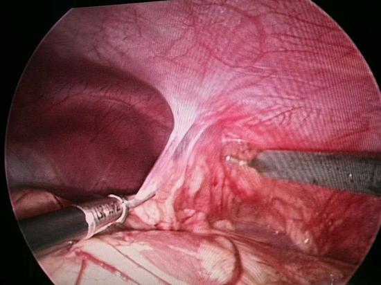 【新浪医讯】哈市儿童医院普外一科成功为4岁