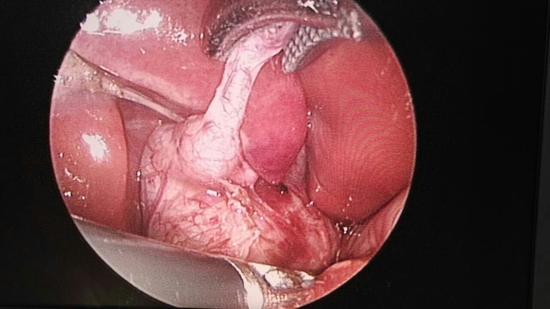 【新浪医讯】哈市儿童医院普外一科为出生42