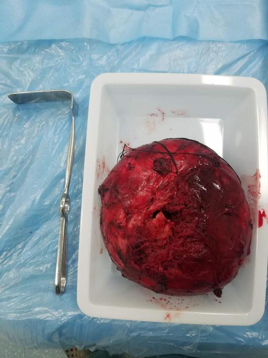 【新浪医讯】六旬老汉摔一跤 颈部肿物突变排