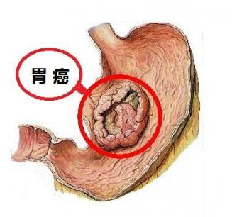胃癌指示图