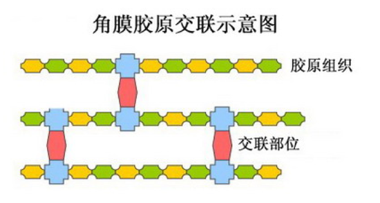 【医讯】哈医大二院完成东北三省首例角膜胶原