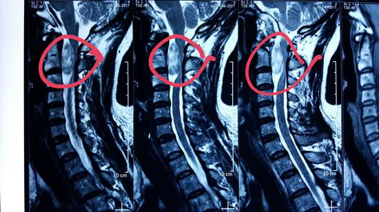 【医讯】哈医大二院骨外科成功为高位颈椎管内