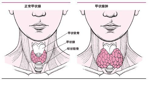 甲状腺正常与非正常对比图