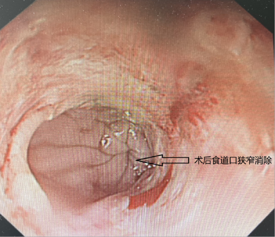 术后食道口狭窄消除