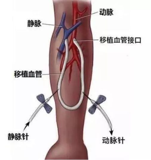 人工血管动静脉通路