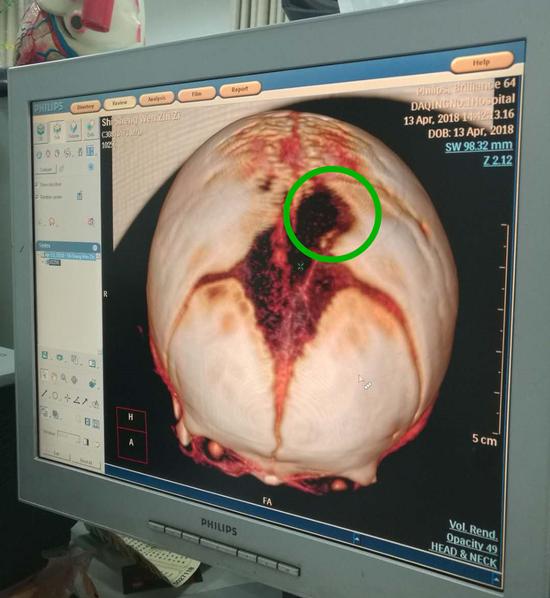 男婴先天颅骨缺损头皮缺损 颅内血管和脑组织清晰可见