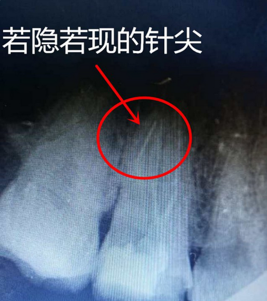 哈尔滨一男子治牙后更疼 原来牙根竟藏4毫米断