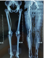 下肢cta显示左下肢动脉被完全堵死