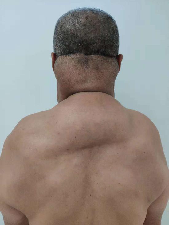 【哈医大四院】酗酒患上马德龙病 医生巧妙切除颈部肿瘤