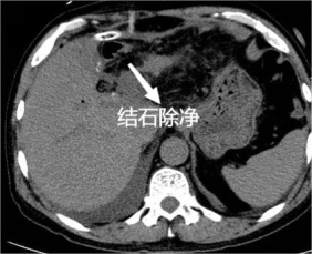 术前、术后 CT 对 比