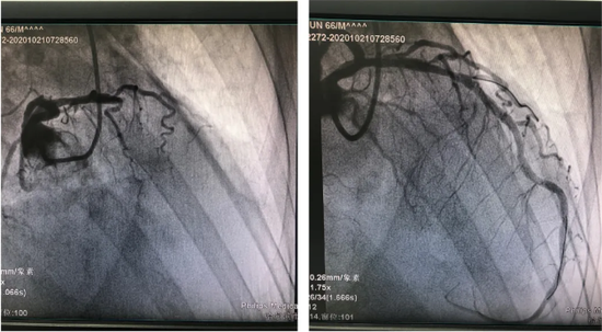 术前：造影显示LAD近段闭塞，有大量血栓，TIMI血流0级   术后：造影显示LAD近段狭窄40%，血流TIMI3级。抽出大量血栓，患者疼痛明显缓解