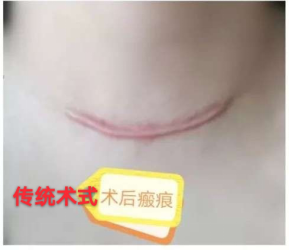 手术疤痕怎么祛除好得快 f9e3-kakmcxe7639606.png