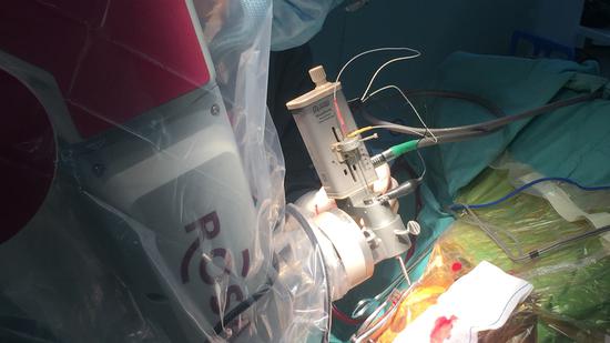 手术医生借助ROSA机器人精准定位电极植入位置