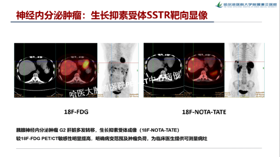 什么叫内分泌肿瘤 f11e-913cb1f1c85c9de79590ac4b8175438f.png