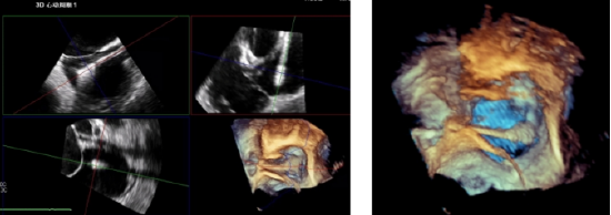 术中超声：三维超声分别精准定位三尖瓣后隔叶和前后叶瓣环位置
