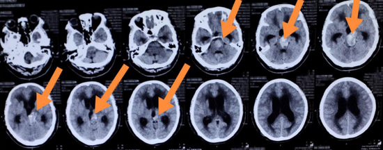  病情发展迅速，脑干血肿增大到了36×26毫米