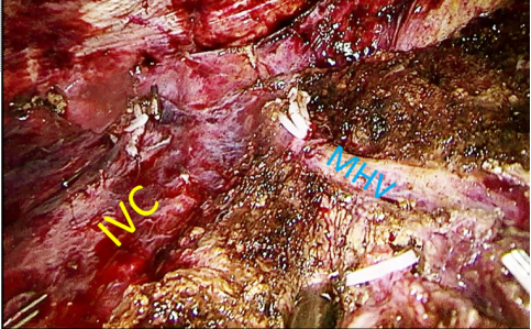 　IVC：下腔静脉 MHV：肝中静脉