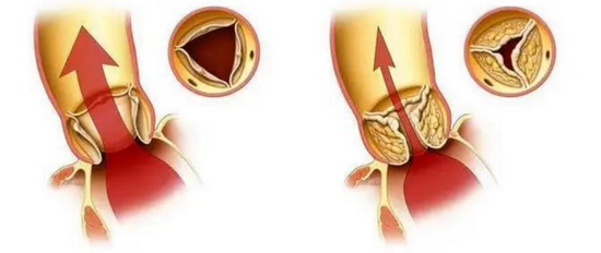 （左图为正常主动脉瓣膜，右图为重度主动脉瓣狭窄）